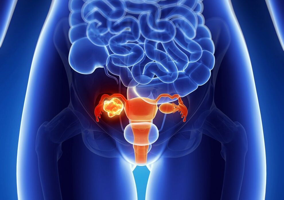 Female ovarian pathology under the influence of alcohol